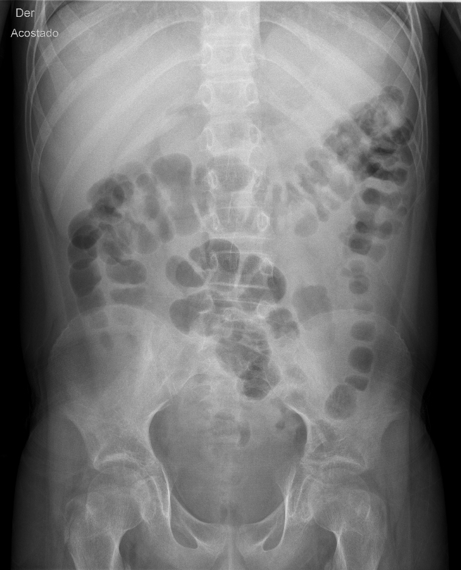 Radiografía simple de abdomen de pie y decúbito con evidencia de lito