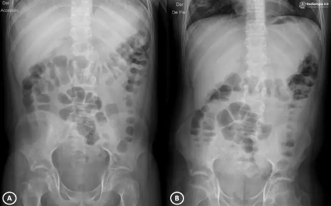 Radiografía de abdomen AP - Radiología 2.0