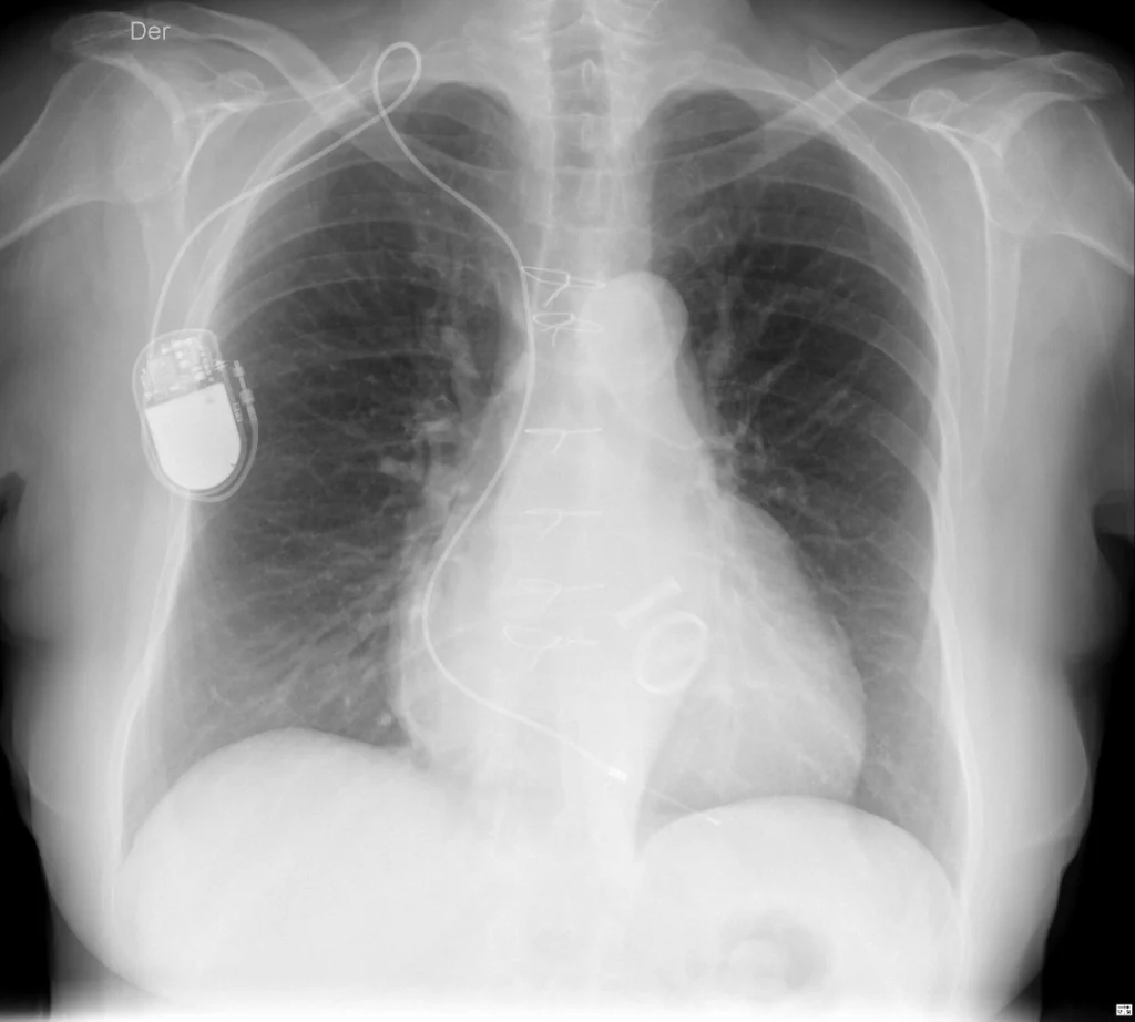 F79 reemplazo bivalvular F79 reemplazo bivalvular