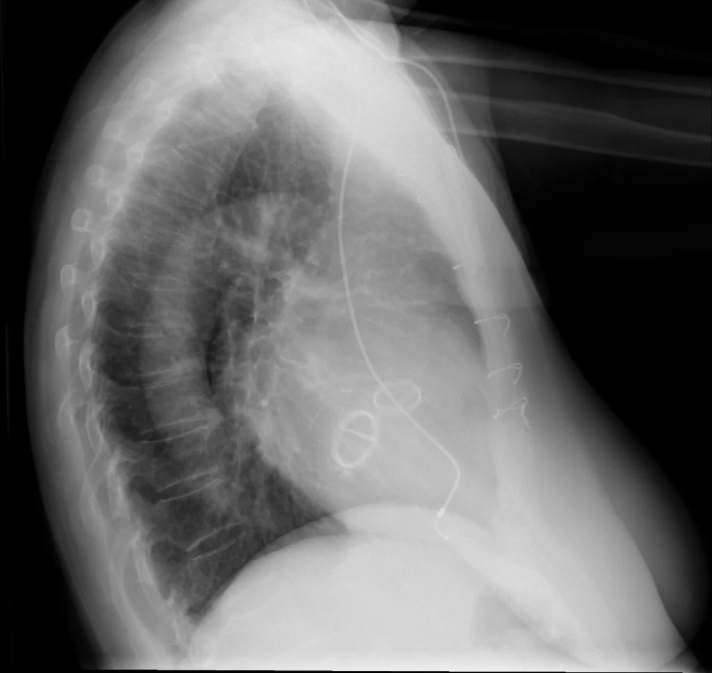 F79 reemplazo bivalvular l F79 reemplazo bivalvular l
