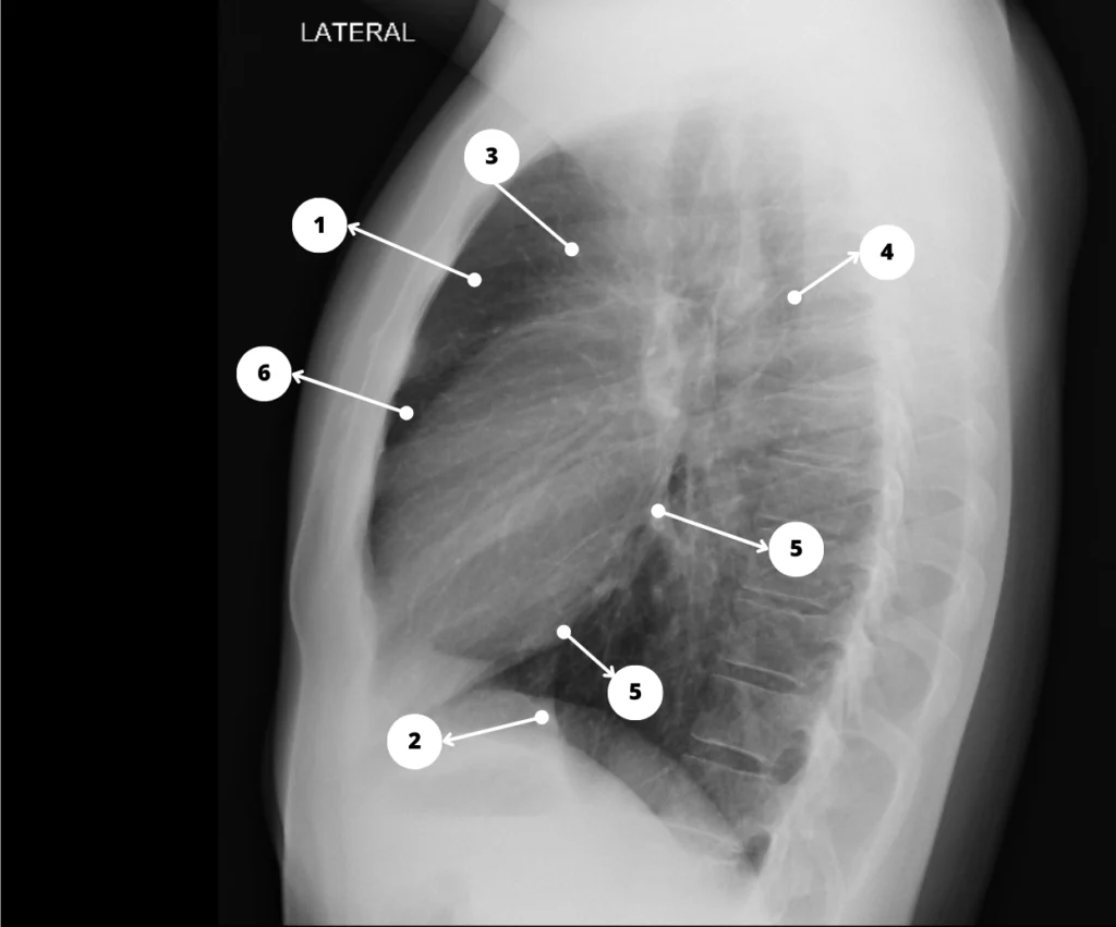 Radiografía de tórax normal LL - Silueta. cardiovascular