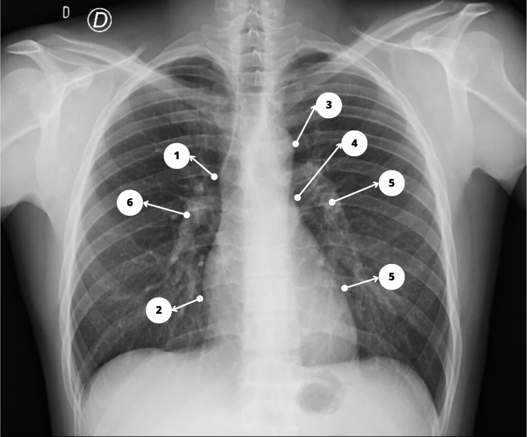 Radiografía de tórax normal PA - Silueta. cardiovascular
