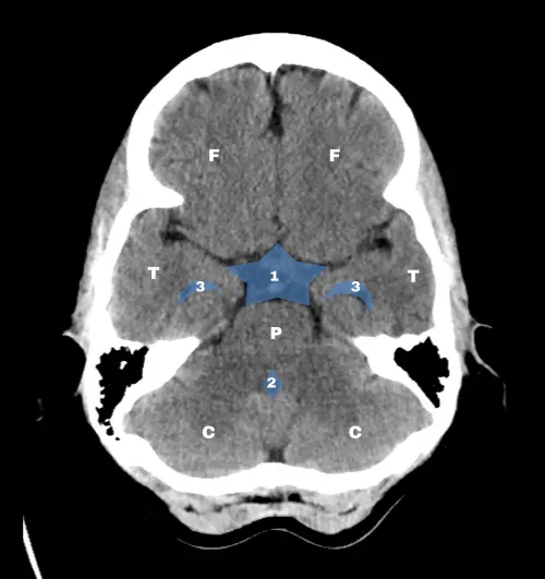 TC cerebro: nivel del tronco encefalico