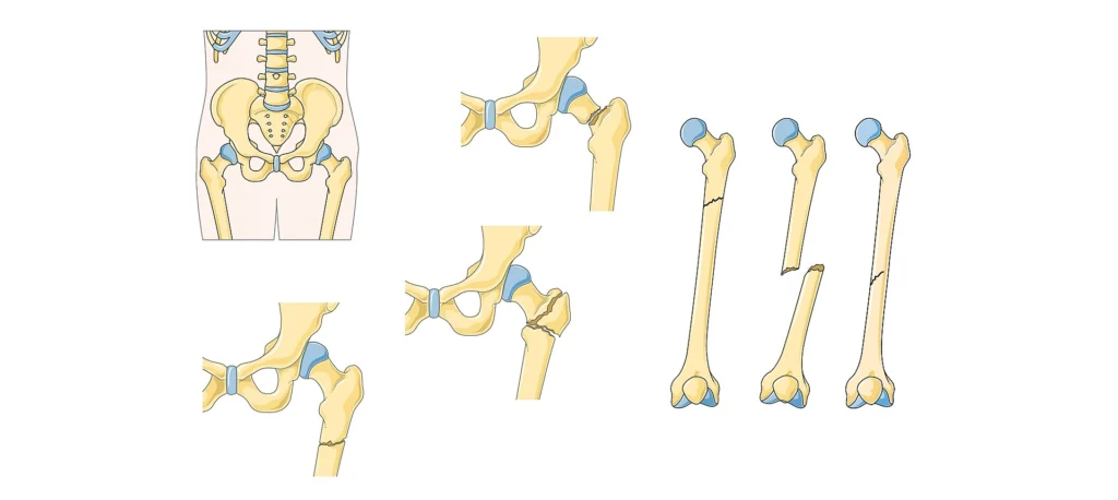 Fracturas del fémur Fracturas del fémur