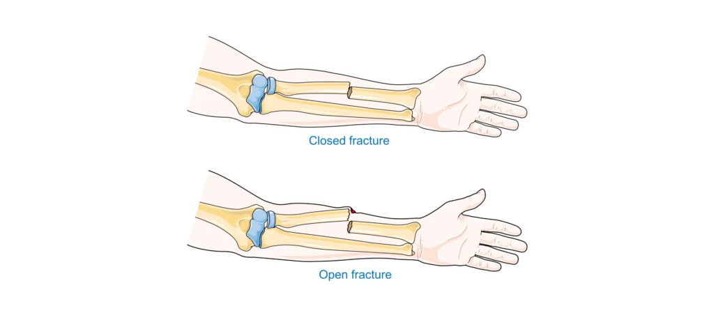 Tipos de fracturas - 3 Tipos de fracturas - 3