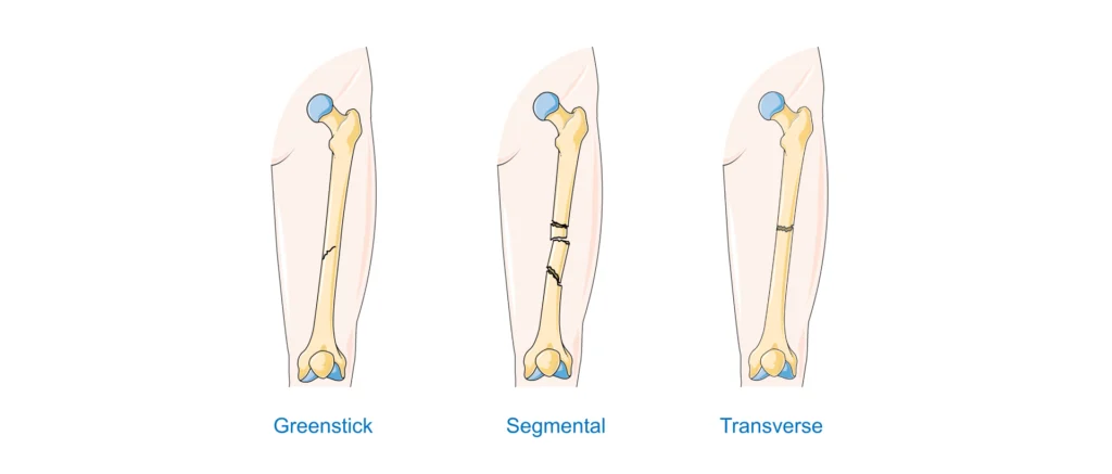 Tipos de fracturas - 2 Tipos de fracturas - 2