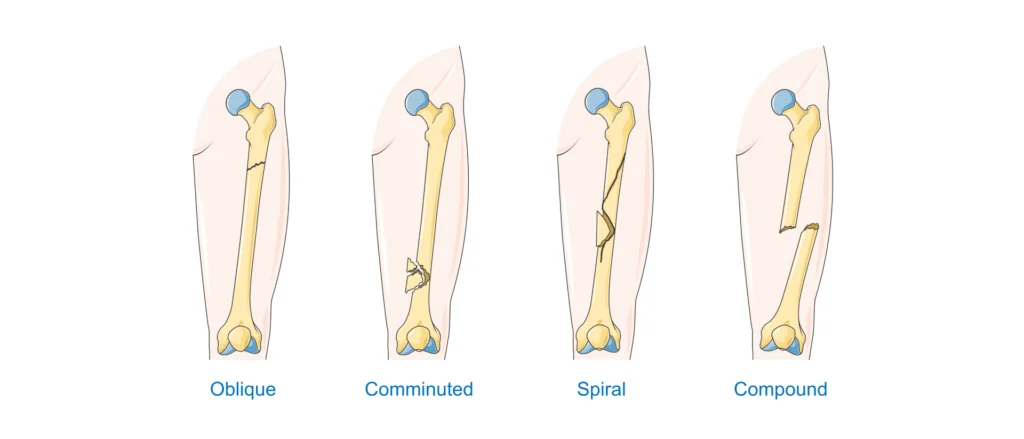 Tipos de fracturas -1 Tipos de fracturas -1
