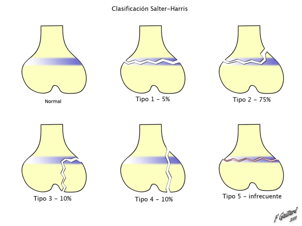 Fracturas de Salter y Harris Fracturas de Salter y Harris
