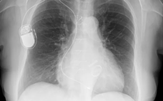 Imagen destacada-PM y reemplazo bivalvular