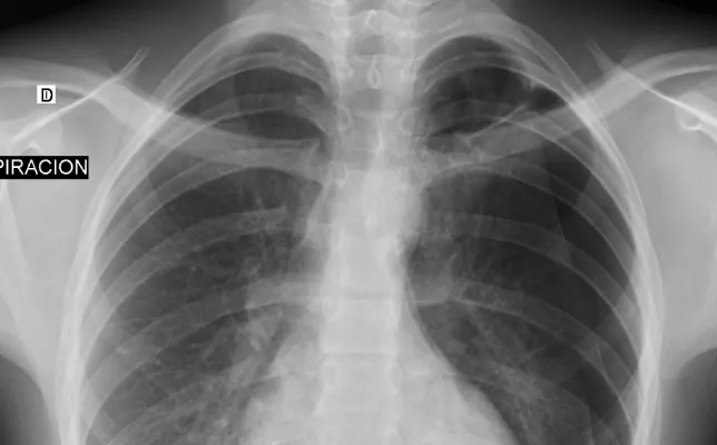 Imagen destacada - neumotorax espontaneo