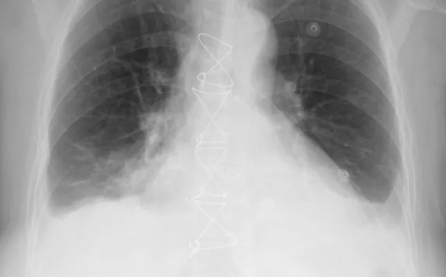 Imagen destacada - derrame pleural