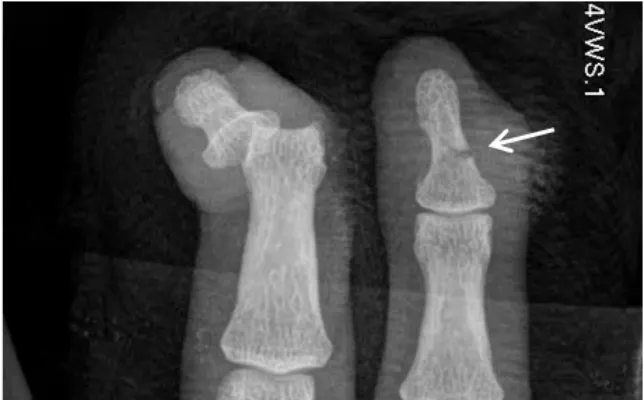 Imagen destacada-Fractura y luxacion dedos