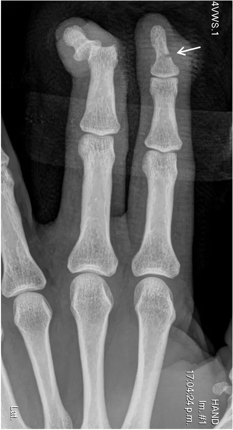 Fractura y luxación en los dedos de la mano