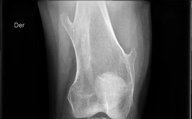 Imagen destacad-osteocondromatosis