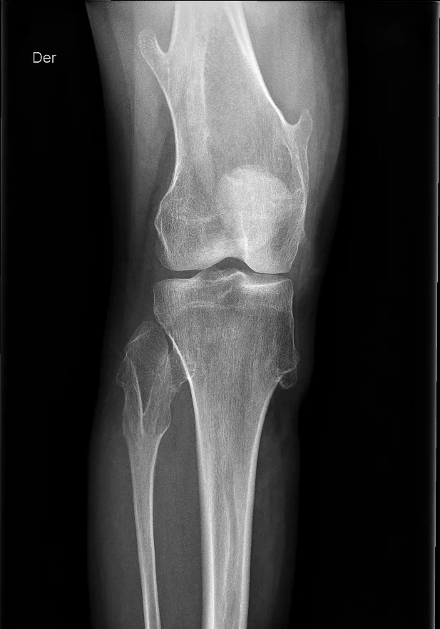 Osteocondromatosis hereditaria múltiple