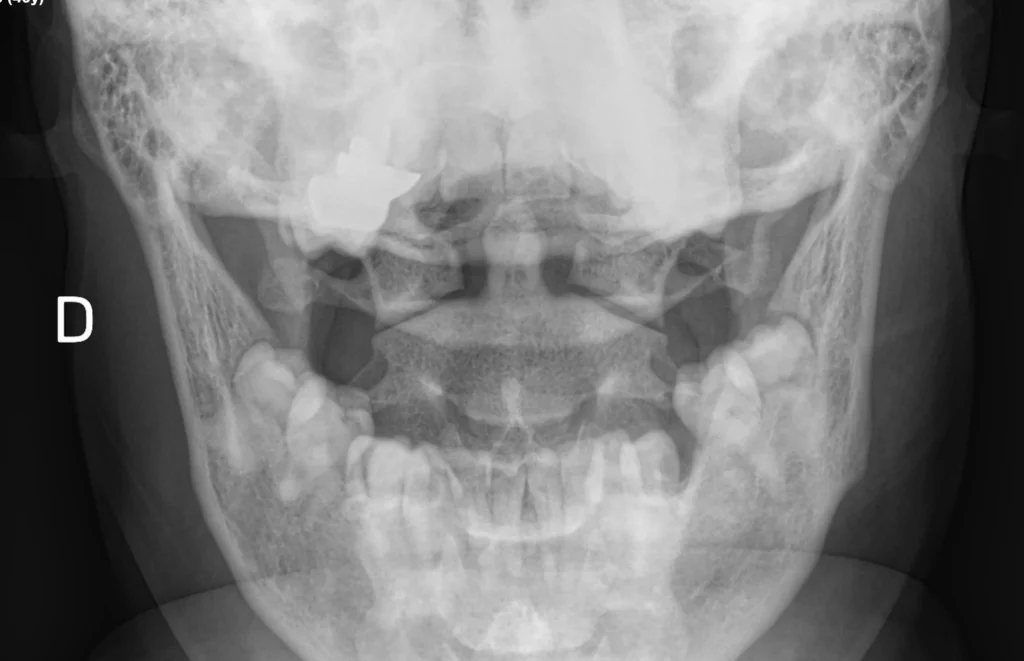 Rx col cervical - trans-oral