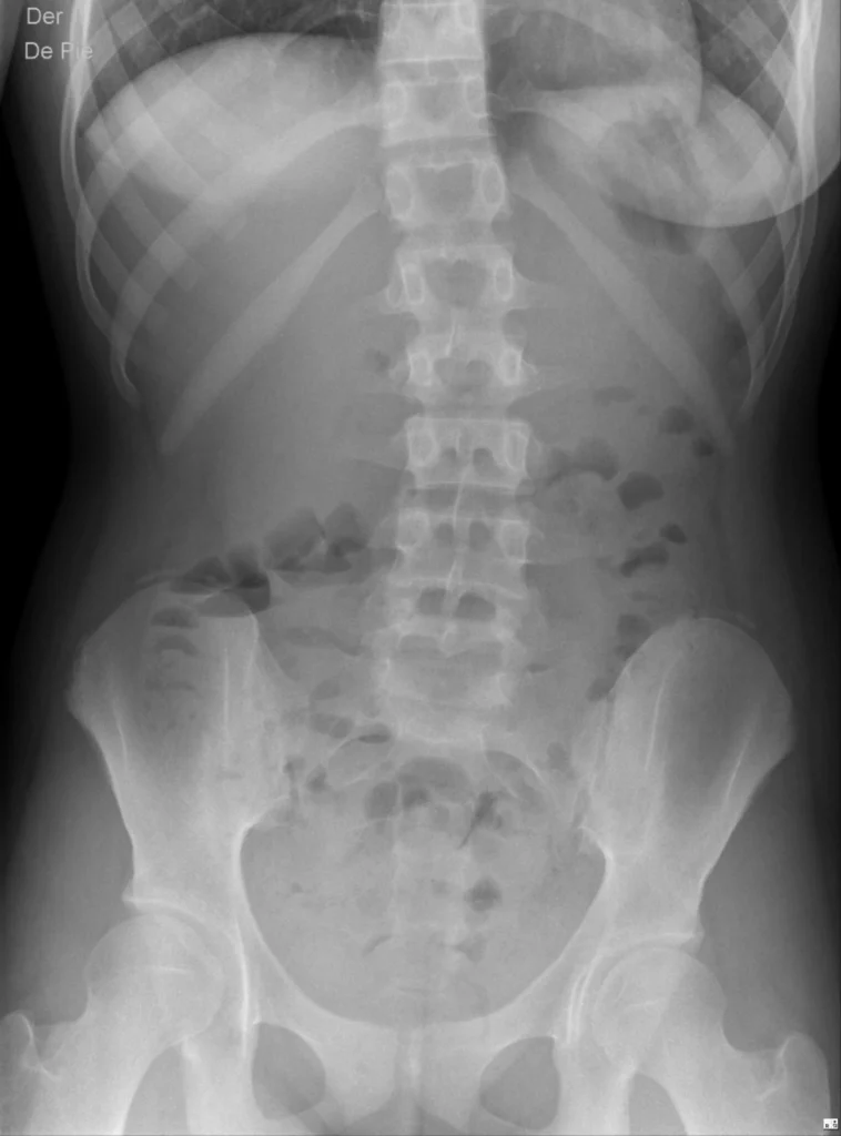 F14-abd-normal-de-pie