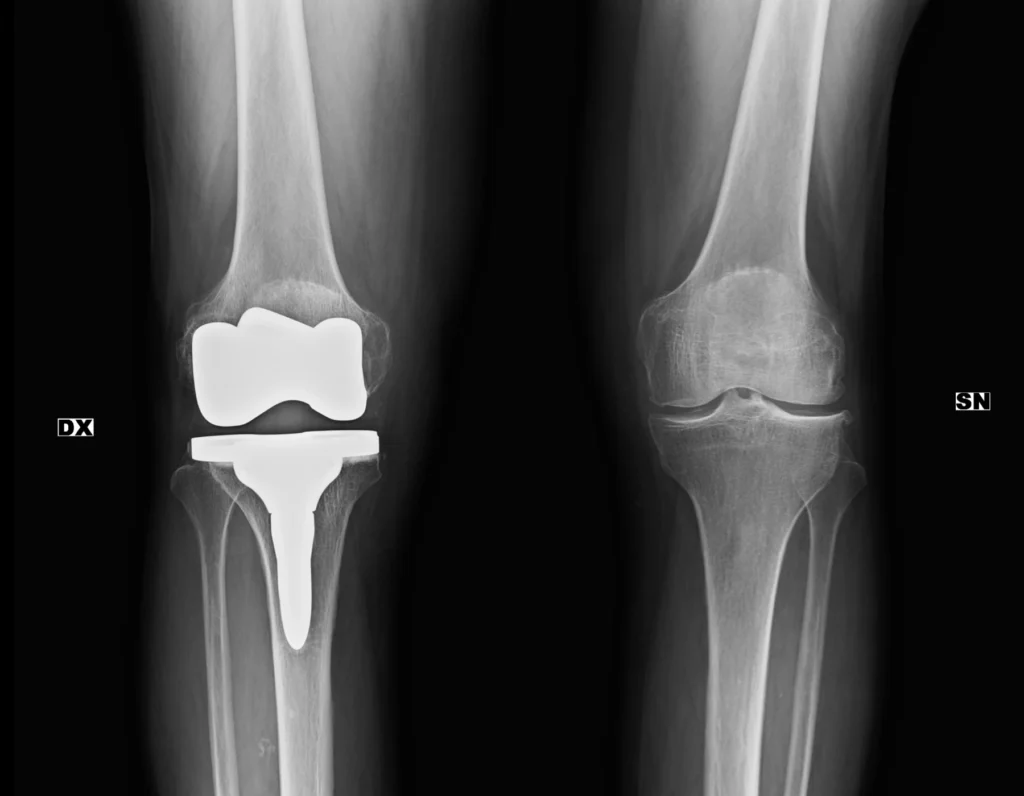 F79-protesi-rodilla-dx