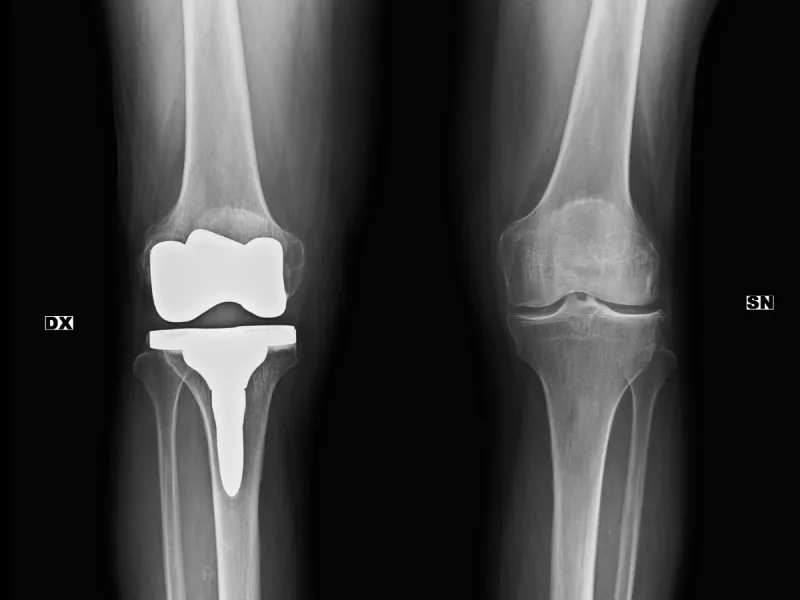 F79-protesi-rodilla-dx-destacada