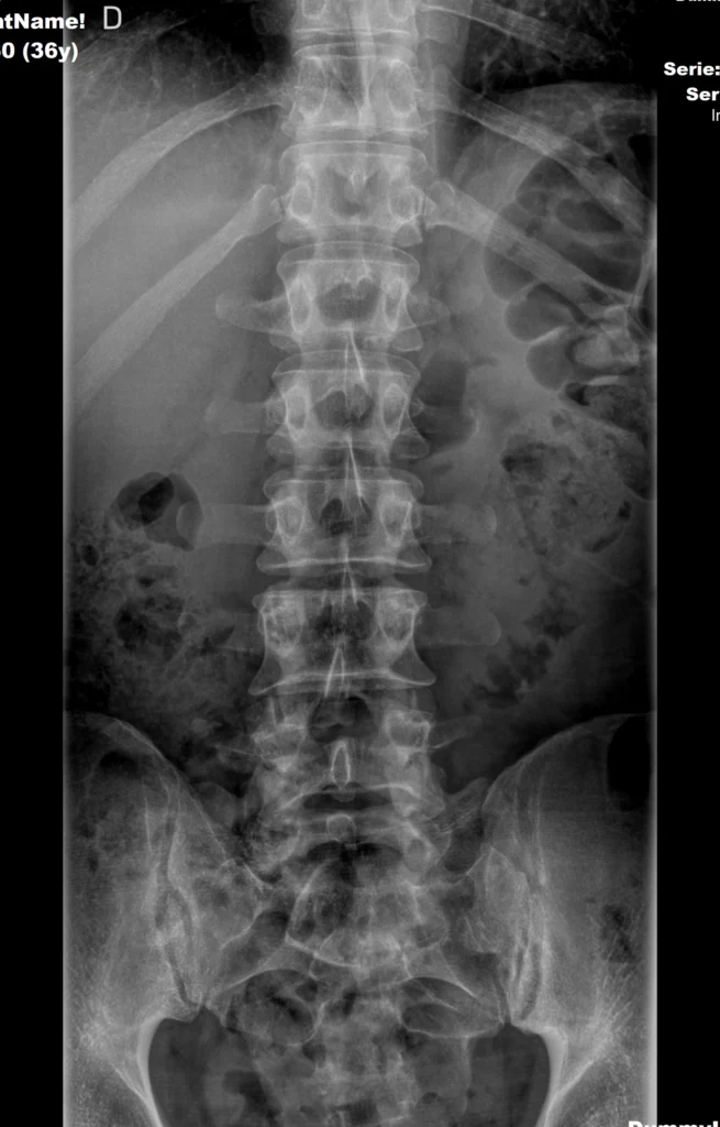M36-col-lumbar-ap