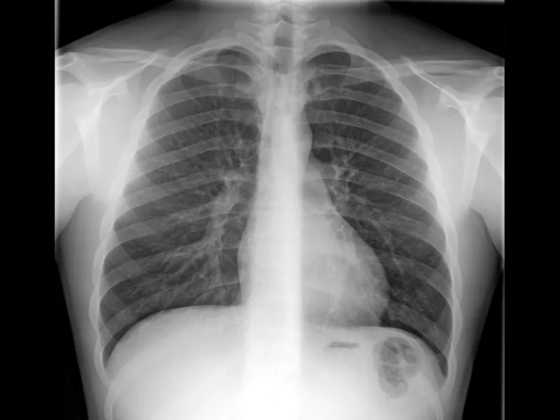 torax-normal-destacada