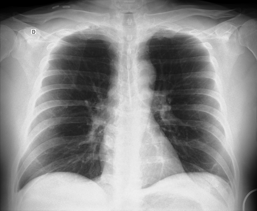 Rx de torax AP en decubito supino