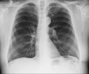 Rx de torax PA en bipedestacion