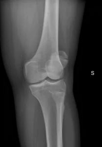 F43-rx-obl2-rotula-bipartita