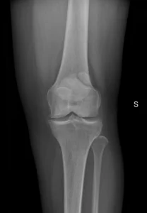 F43-rx-ap-rotula-bipartita