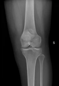 F43-rx-obl1-rotula-bipartita