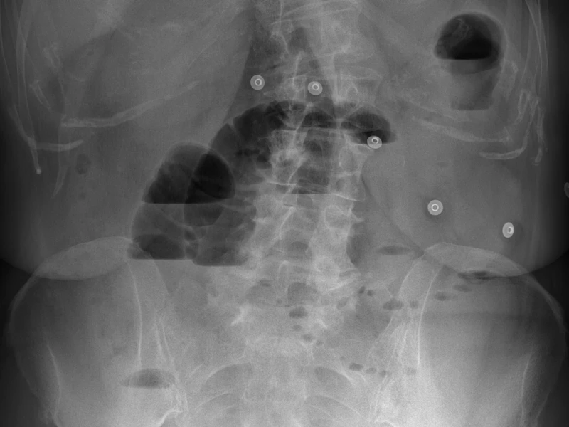 Signo del collar de perlas