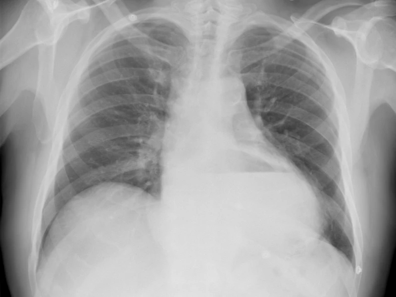 F74-Hernia-hiatal-destacada