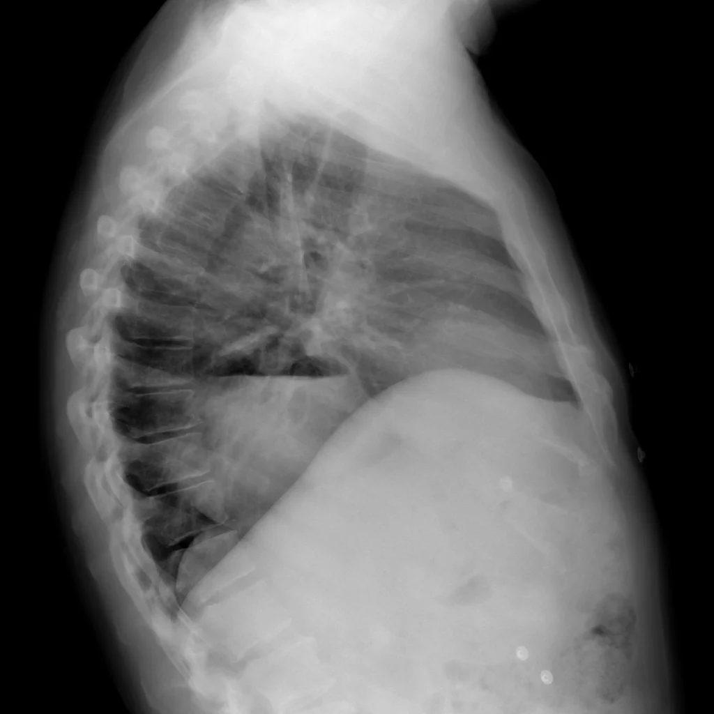 F74-RxTorax-LL-Hernia-hiatal