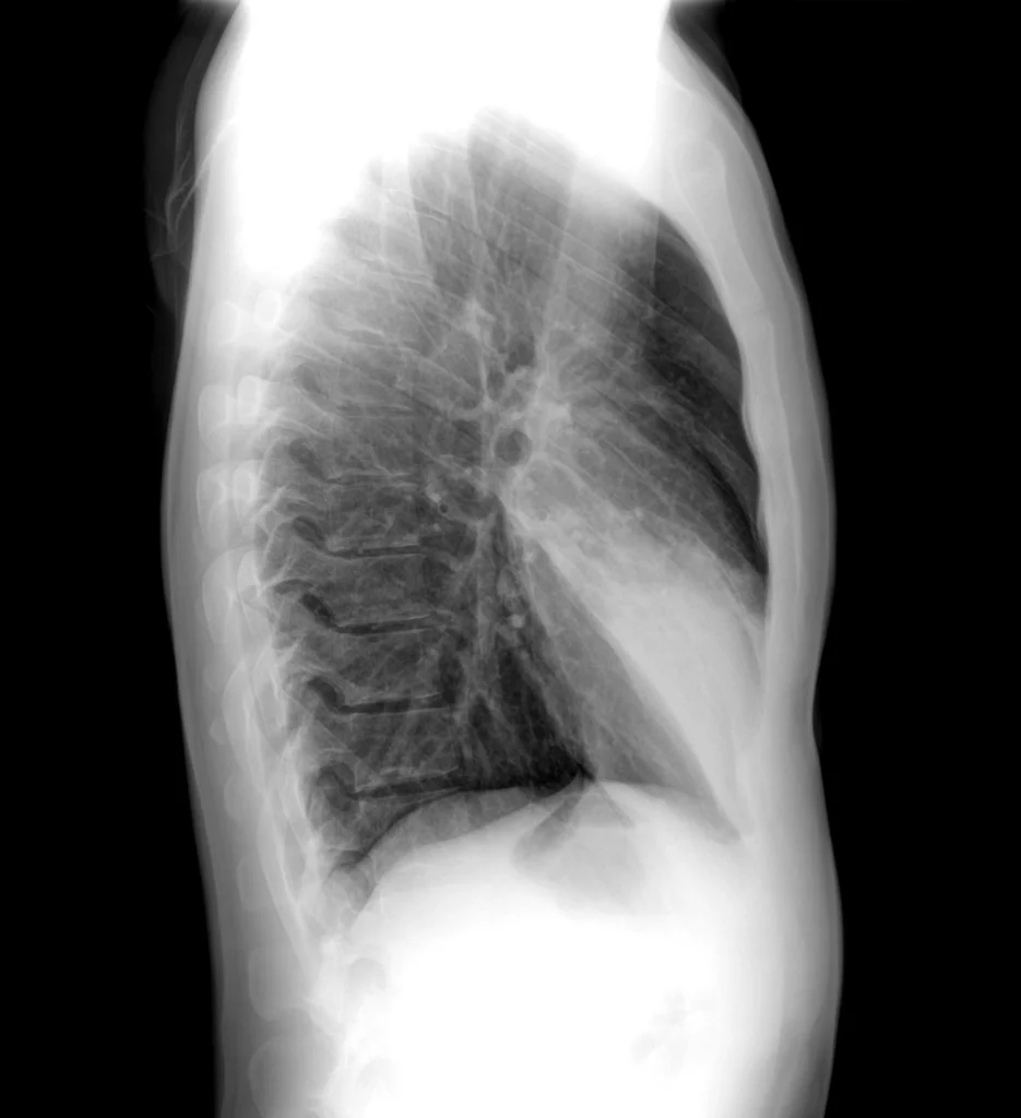 Signo de la silueta - LL- Consolidacion del lobulo medio