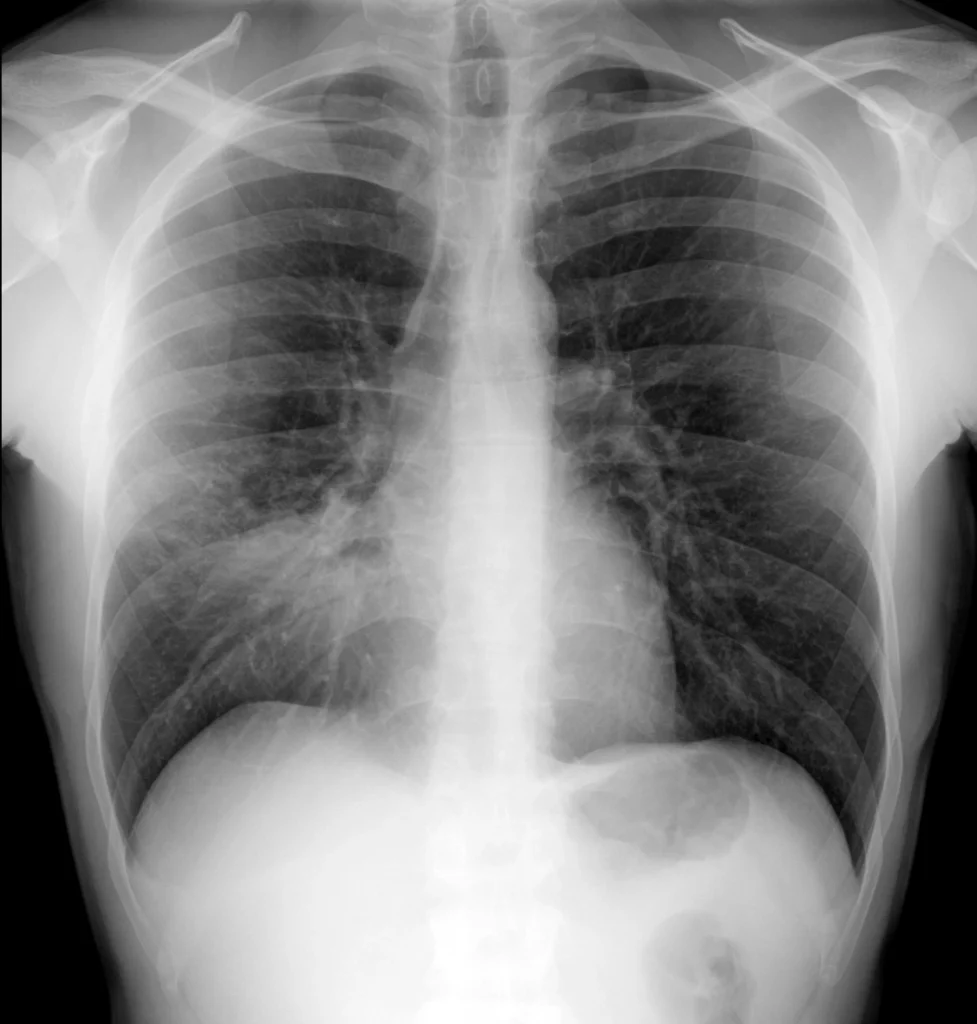 Signo de la silueta - PA- Consolidacion del lobulo medio