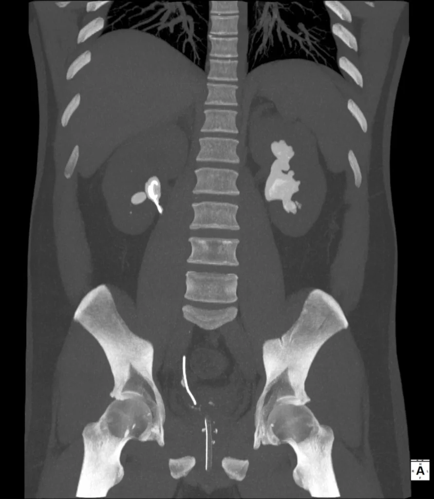 TC abd sin mdc - MPR - Lito-coraliforme TC abd sin mdc - MPR - Lito-coraliforme