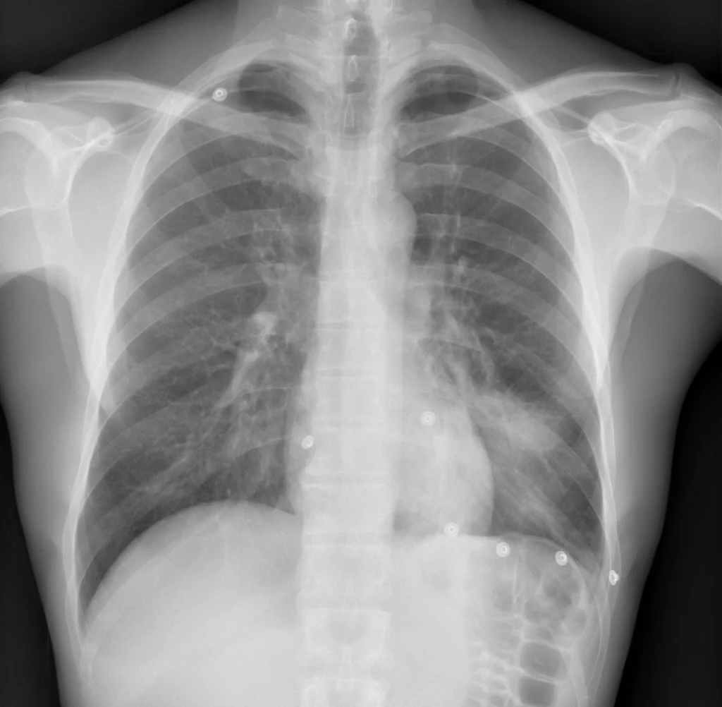 Signo de la silueta negativo - PA - Consolidacion LII Signo de la silueta negativo - PA - Consolidacion LII