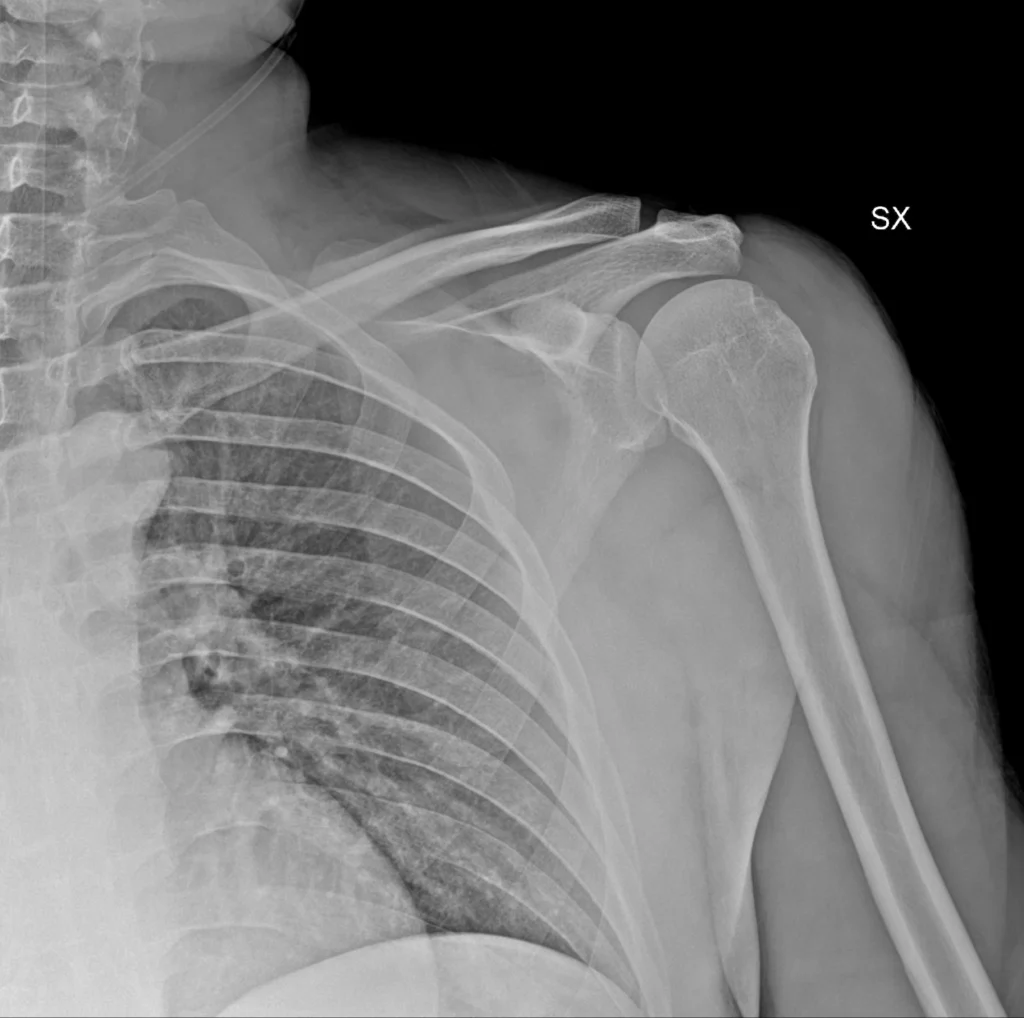 rx-hombro-luxacion-antinf-1