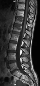 F52-rm-sag-t1-fx-D12-L1