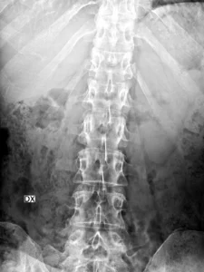 F52-rx-ap-fx-D12 y L1