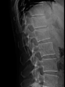 F52-rx-lat-fx-D12 y L1