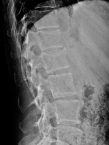 F52-rx-lat-fx-D12y L1 focal