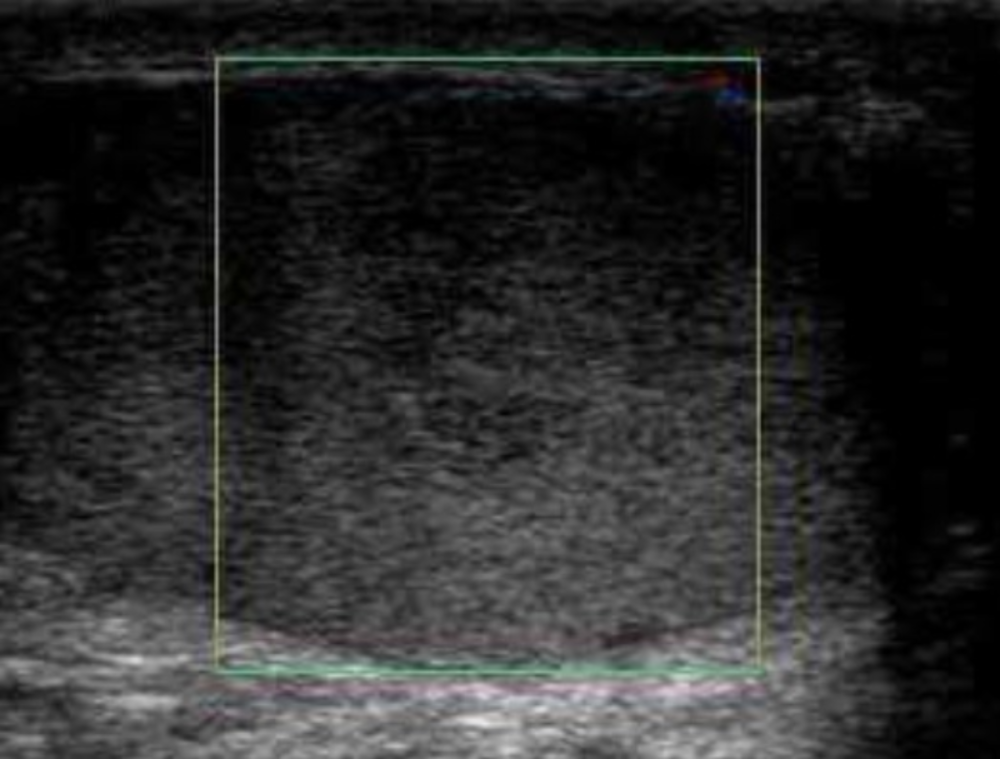 Torsión de testiculo - eco doppler