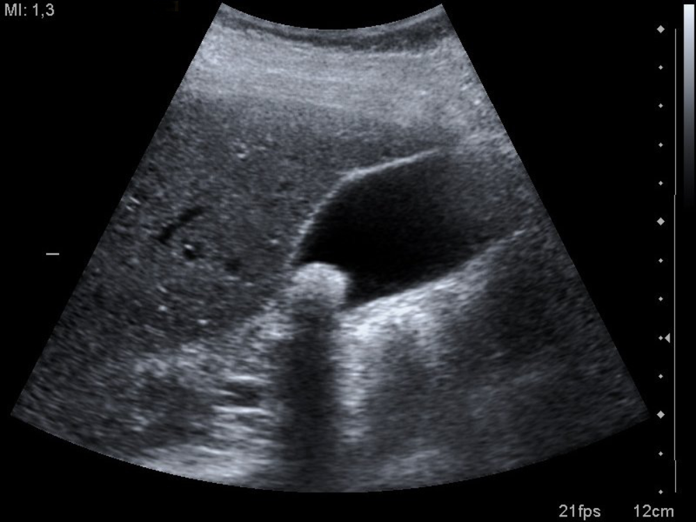 ecografia-litiasis-biliar ecografia-litiasis-biliar