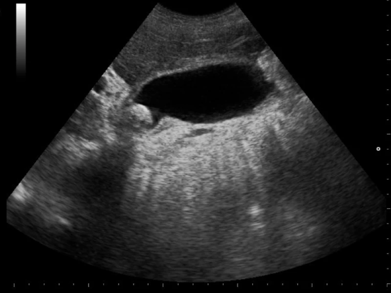 litiasis-biliar-destacada