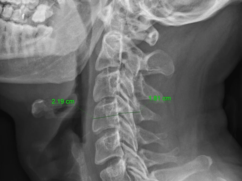 rx-col-cerv-lat-torg-c4