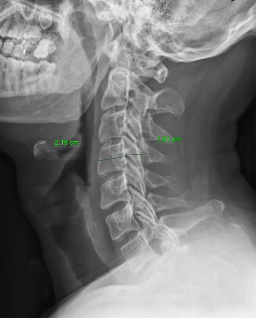 Indice de Pavlov y Torg